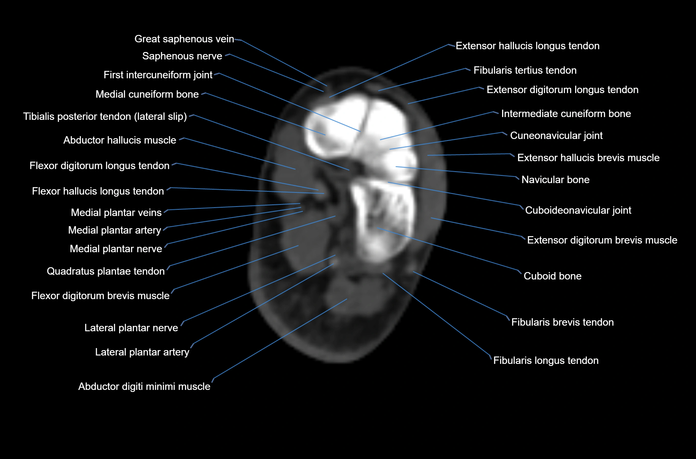 CT Ankle axial cross sectional anatomy labelled image -00049.webp
